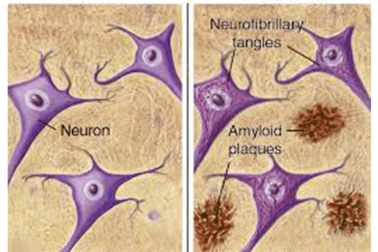 Da dove origina l'Alzheimer?